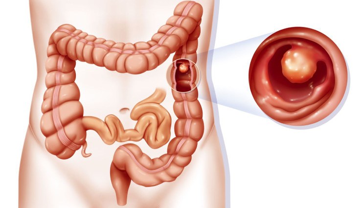 Gardner syndrome