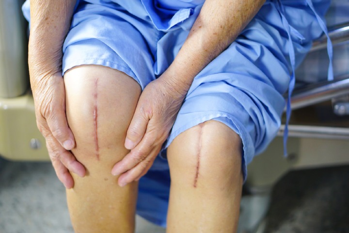 Knee joint replacement surgery