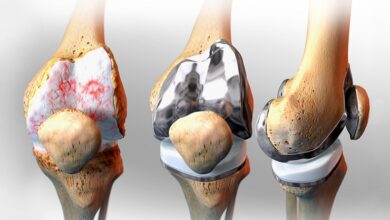 Knee joint replacement surgery